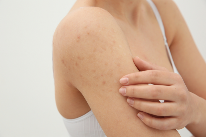 Everything You Need to Know About HIV Rash