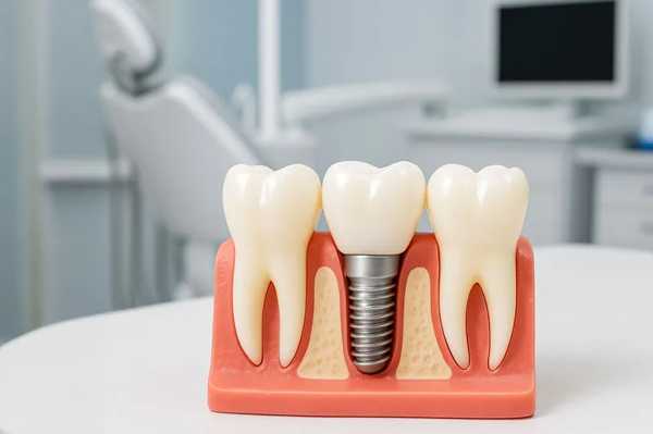 Advanced Dental Implant Innovations for Long-Term Oral Health
